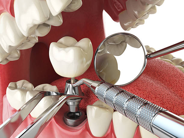 Best Emergency Tooth Extraction in Hickory, NC